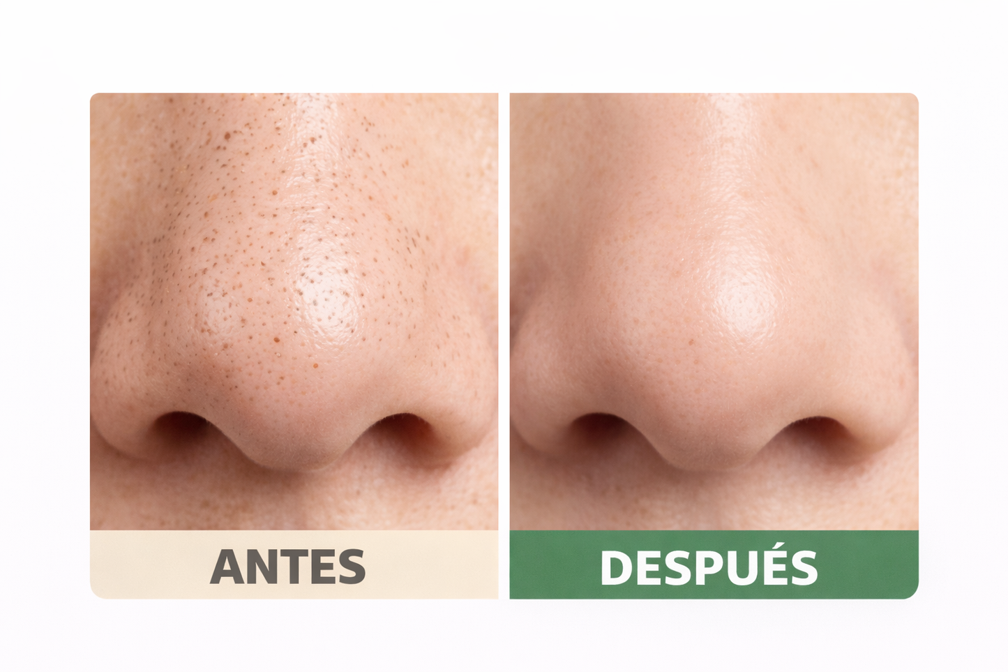 Eliminador Profesional de Puntos Negros - Limpieza Facial en Casa