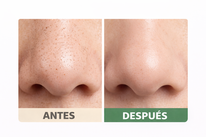 Eliminador Profesional de Puntos Negros - Limpieza Facial en Casa